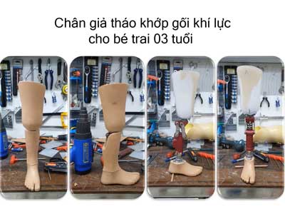 Chân giả tháo khớp gối